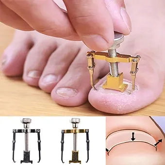 Ingrown Toenail Correction Device - Mystery Gadgets ingrown-toenail-correction-device, Health