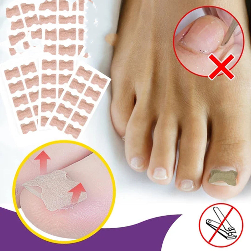 Toenail Correction Stickers - Mystery Gadgets toenail-correction-stickers, Toenail Correction Stickers