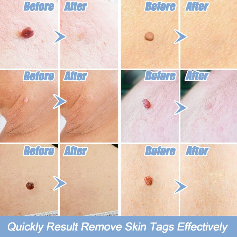 Skin Tag Removal Kit - Mystery Gadgets skin-tag-removal-kit, Health & Beauty