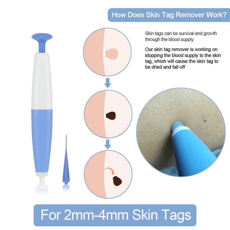 Skin Tag Removal Kit - Mystery Gadgets skin-tag-removal-kit, Health & Beauty