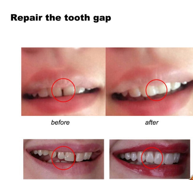 Temporary Tooth Gap Repair Kit - Mystery Gadgets temporary-tooth-gap-repair-kit, Health, Health & Beauty