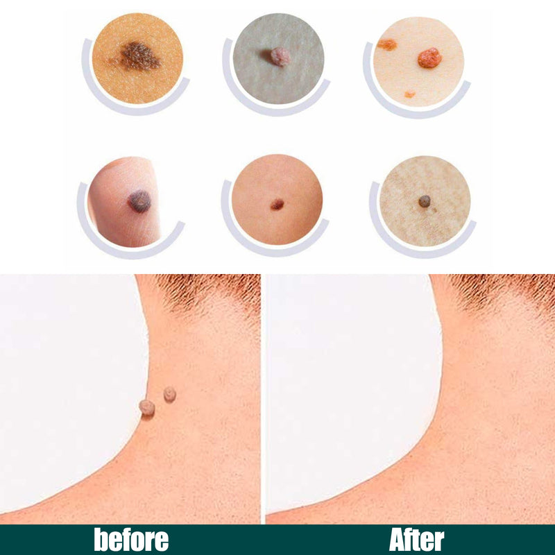 Skin Tag Remover Patches - Mystery Gadgets skin-tag-remover-patches, 