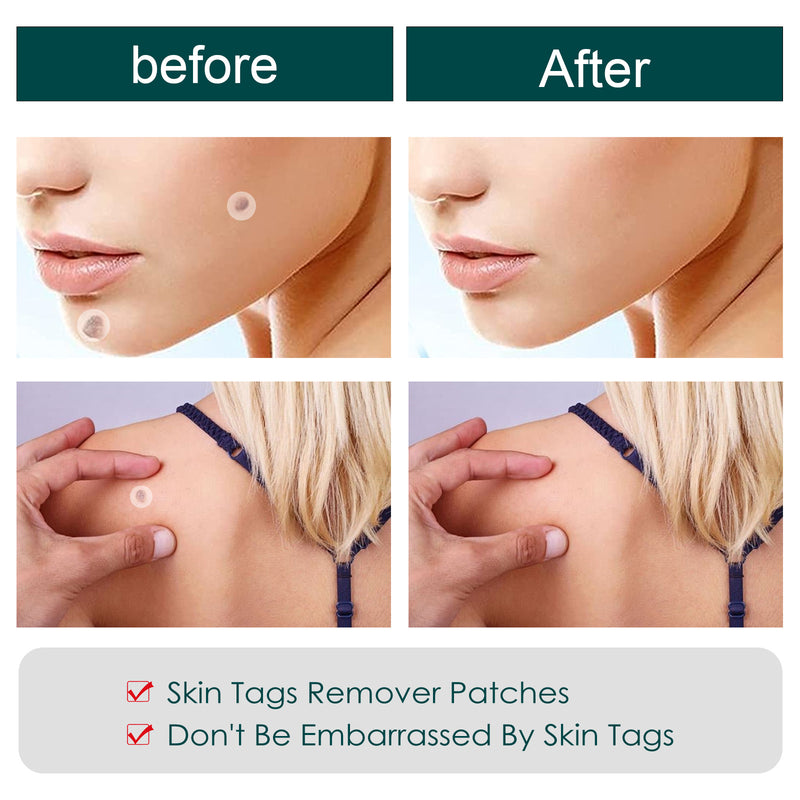 Skin Tag Remover Patches - Mystery Gadgets skin-tag-remover-patches, 